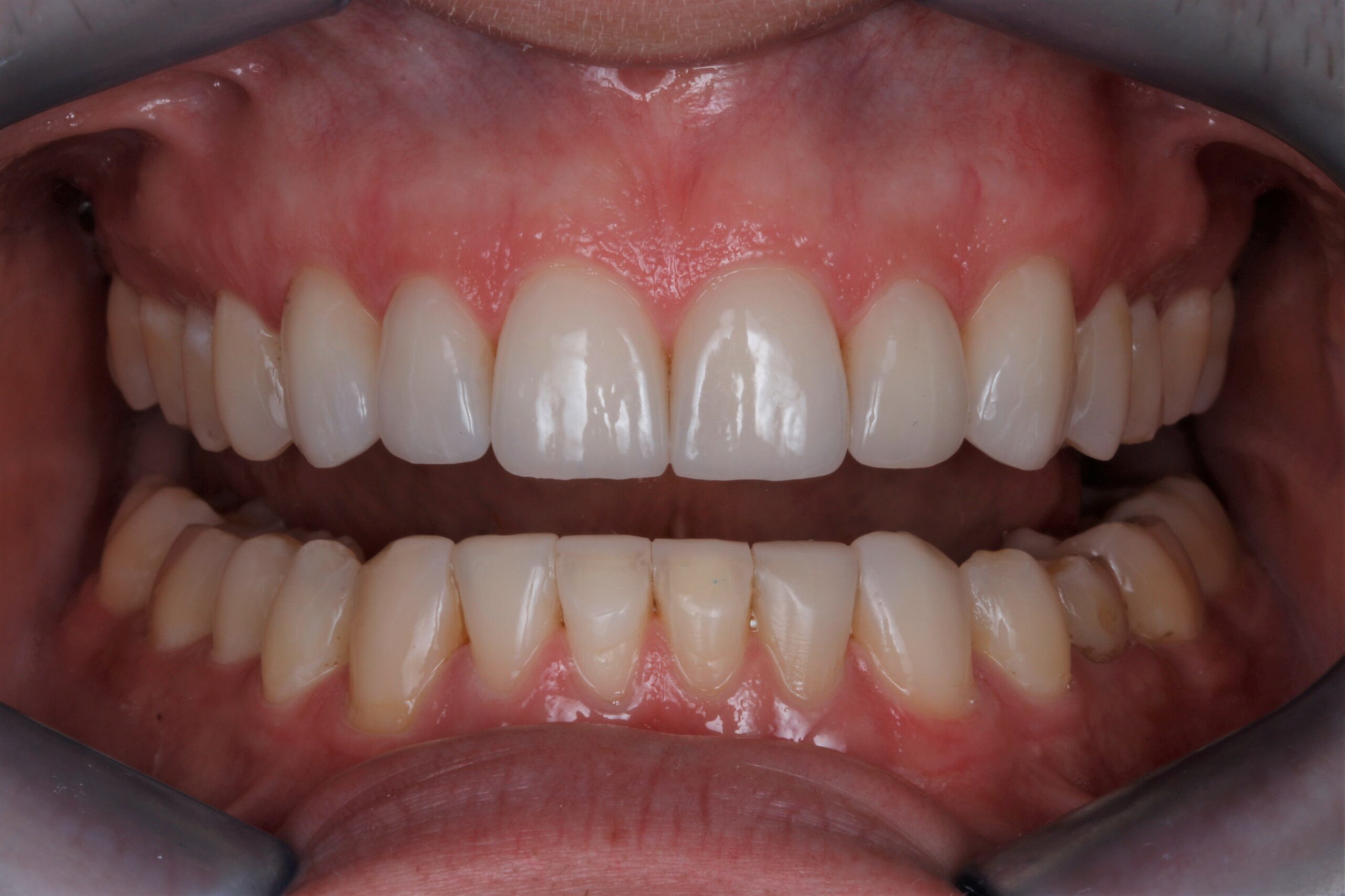 Tooth Wear Treatment After Procedure Image