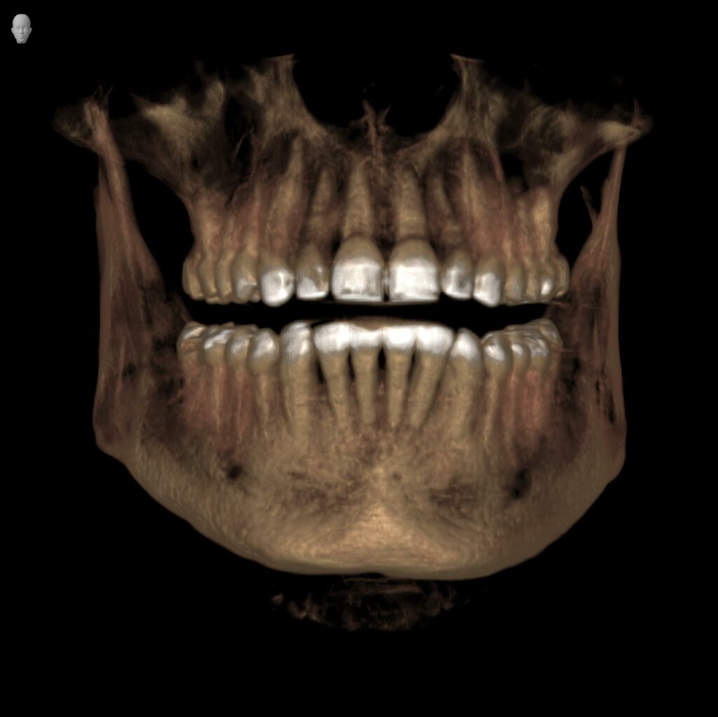 3D scan of patient with chronic oral infection