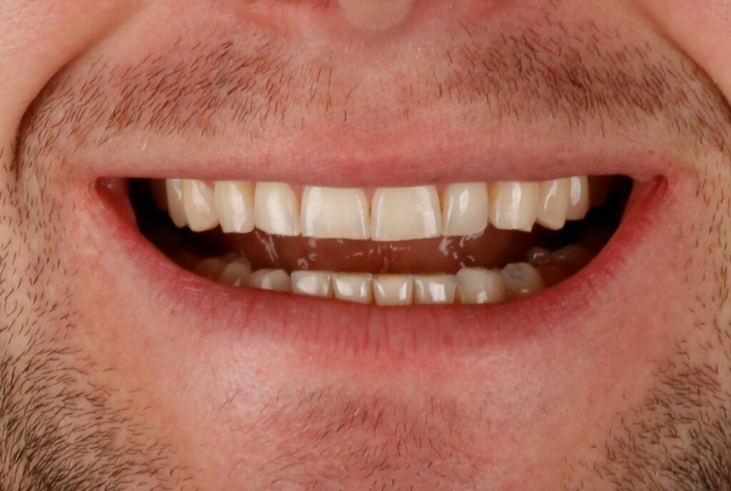 Tooth Wear Treatment : Before Treatment Image