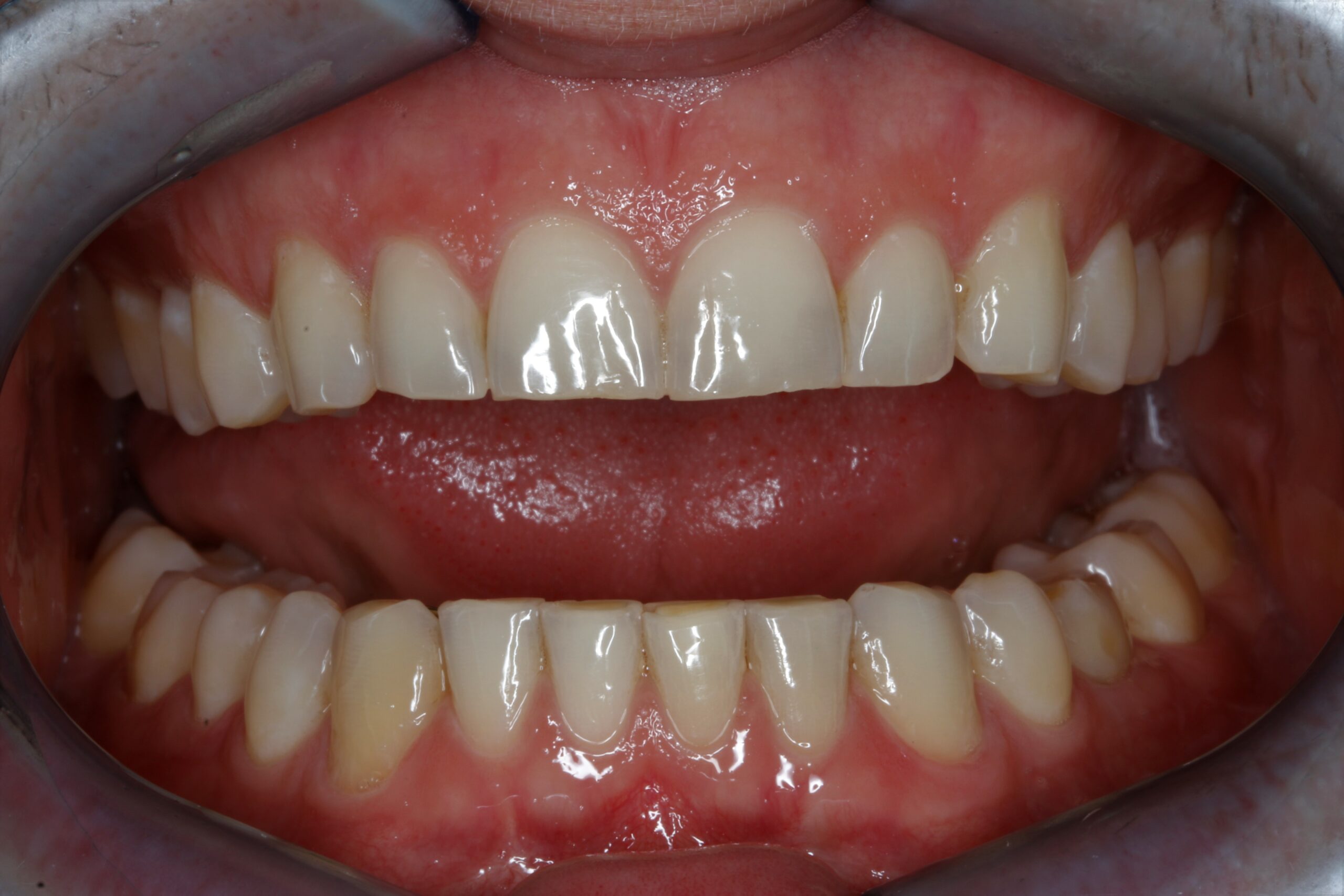 Tooth Wear Treatment Before Procedure Image