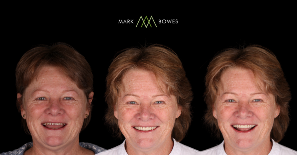 Smile Makeover Dr Mark Bowes Digital Treatment planning