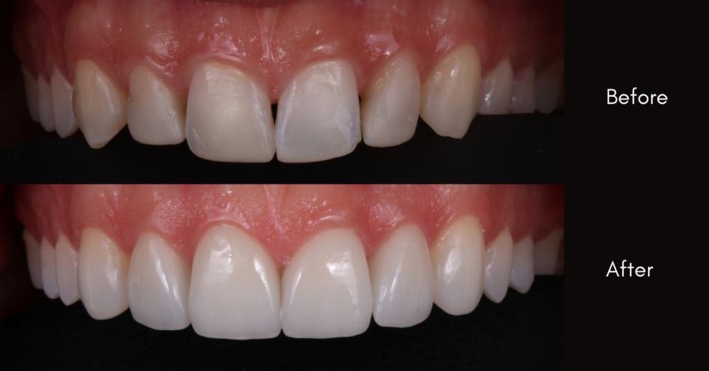 Dr Mark Bowes Smile Rehabilitation Enamel Enamel Dentistry