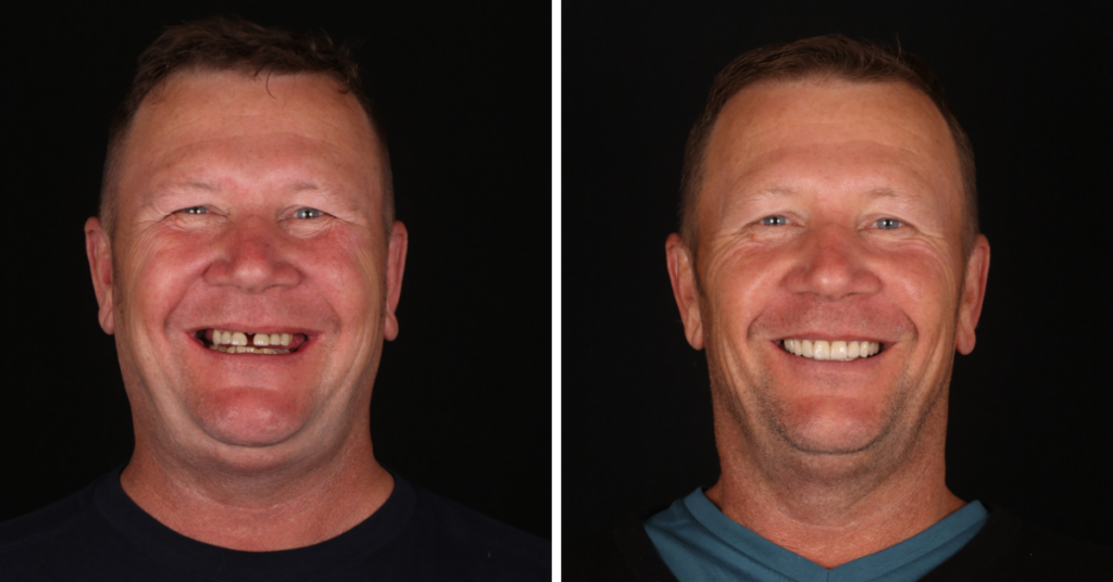 Example of successful smile transformation