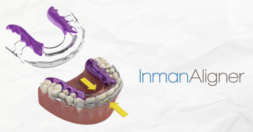 Inman Aligners are used to help straighten teeth