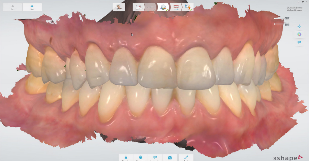 Dental Technology - our Intraora scanner creates clear impressions