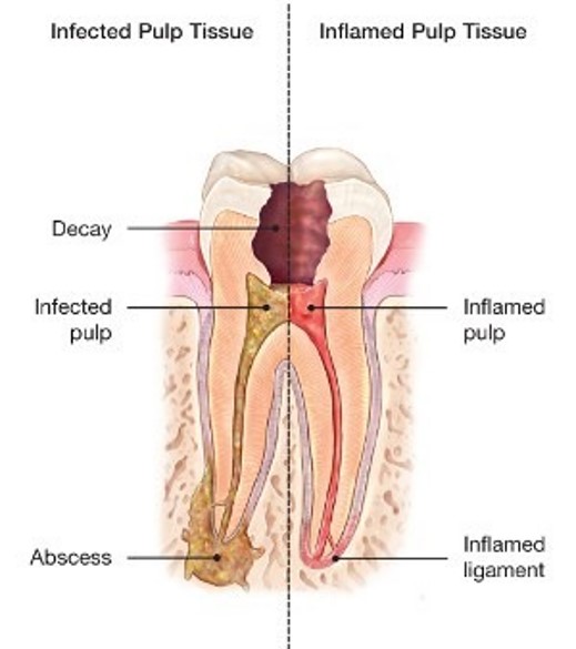 Image showing inflamed and infected pulp tissue, needing root canal treatment