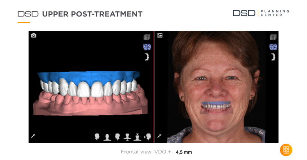 Front view of a smile make over treatment planning