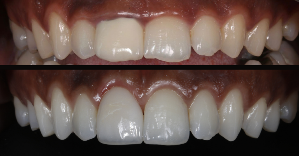 Before and After smile rehabilitations