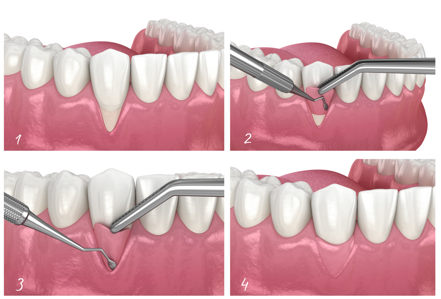 Gum Recession - Causes And Treatment - Enamel Clinics