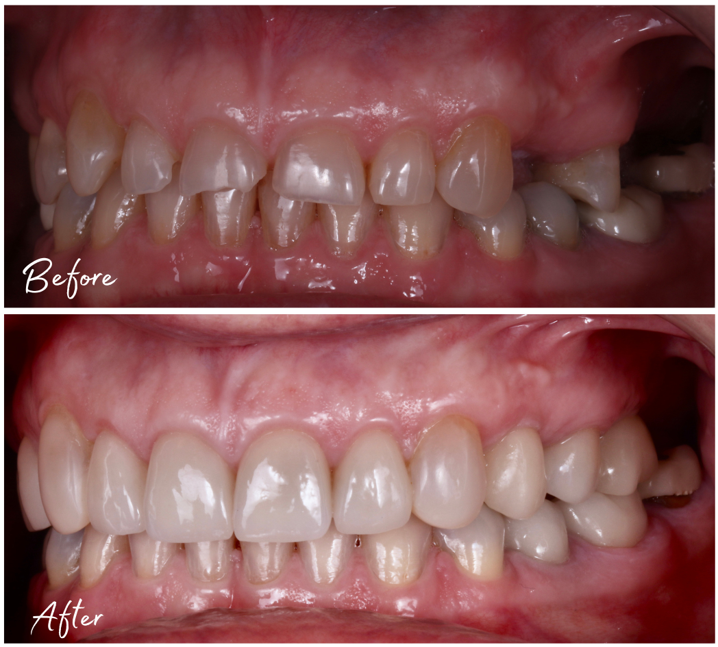 Tooth Wear case by Dr Mark Bowes