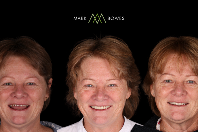 Mark-Bowes-Digital-Planning-Smile-Makeover