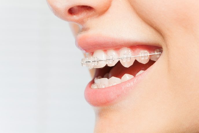 Side view picture of woman's smile with clear dental braces on teeth against blanked background