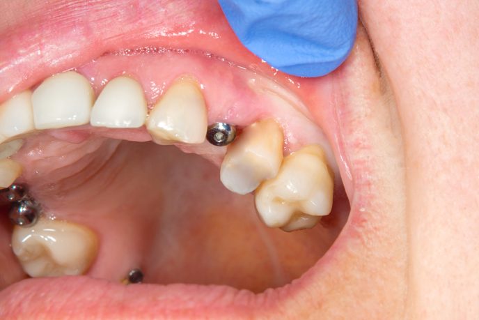 Close-up dental implant wort patient in a dental clinic during treatment. The concept of surgical aesthetic dentistry