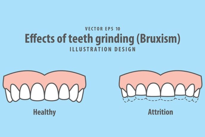 Effects of teeth grinding (Bruxism) illustration vector on blue background. Dental concept.